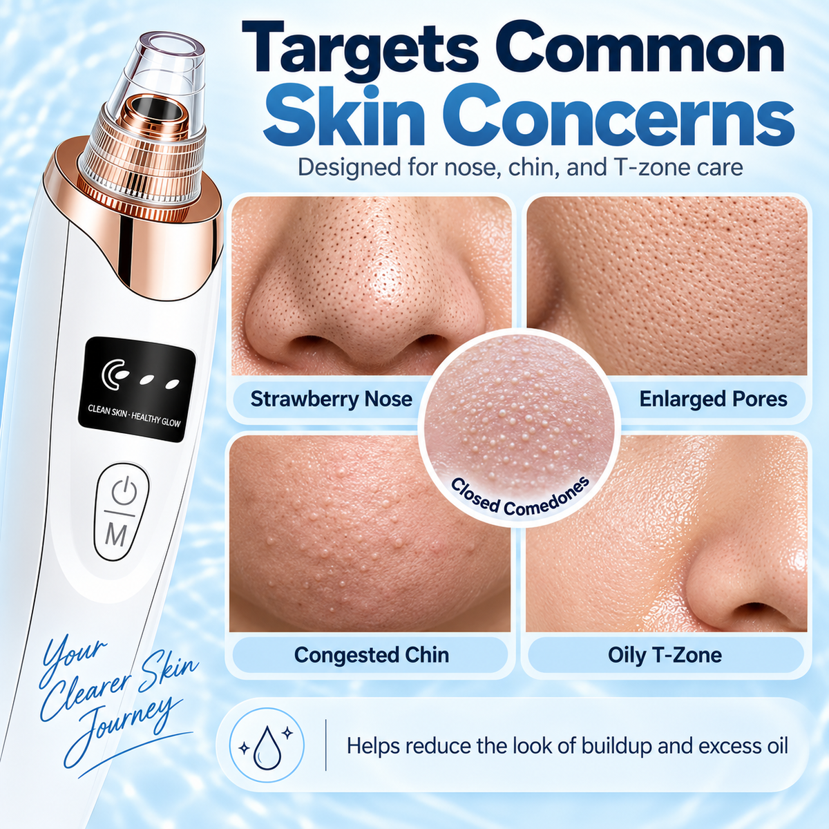 Blackhead remover