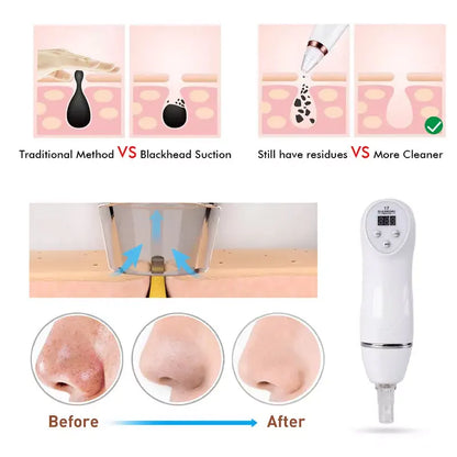 Blackhead Remover Vacuum Pore Cleaner